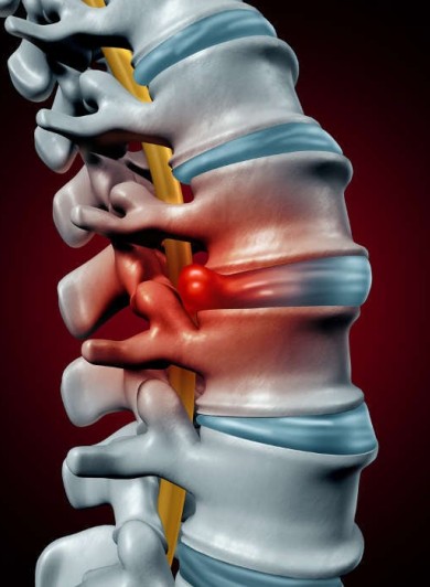 Il tratto dorsale: l’ernia del disco