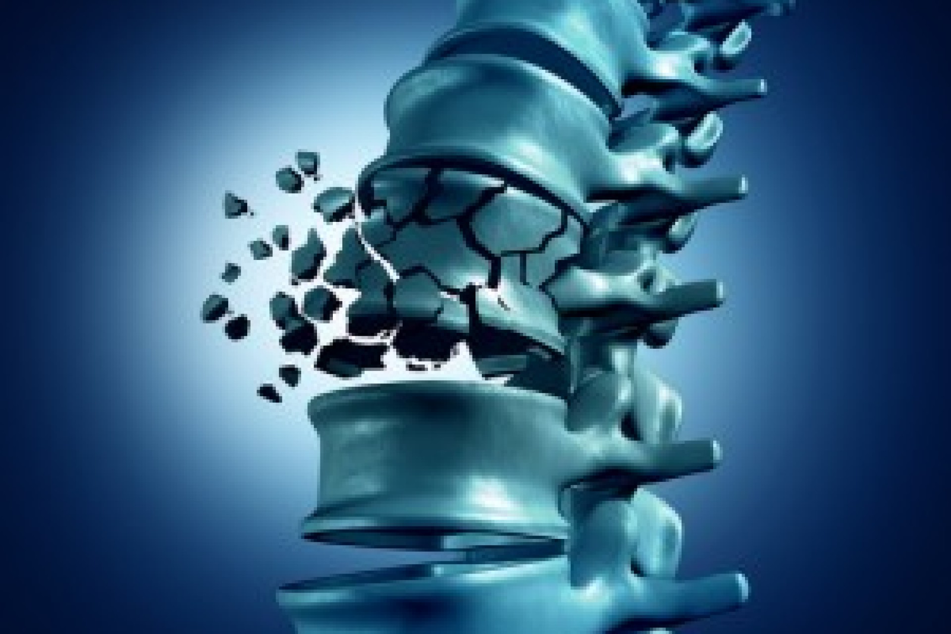 Il tratto dorsale: le fratture vertebrali