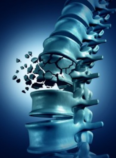 Il tratto dorsale: le fratture vertebrali